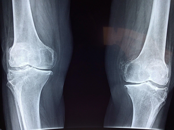 Why your next knee surgery may be assisted by smart glasses